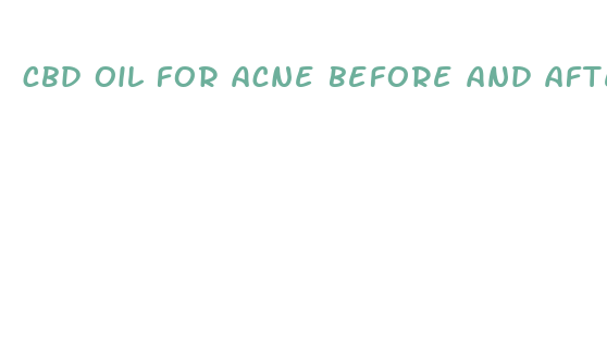 cbd oil for acne before and after