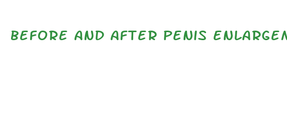 before and after penis enlargement surgery