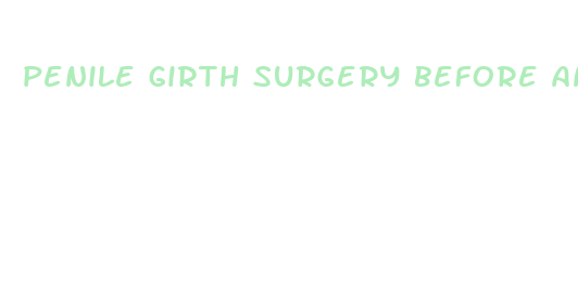 penile girth surgery before and after