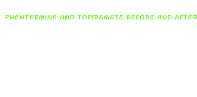 phentermine and topiramate before and after