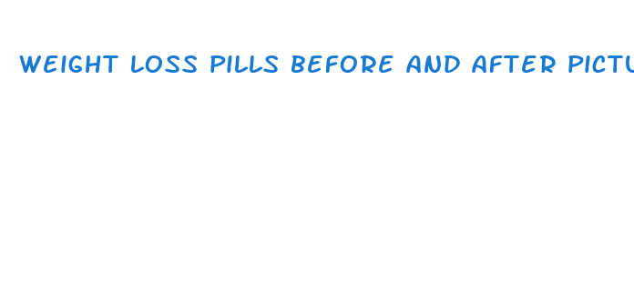 weight loss pills before and after pictures